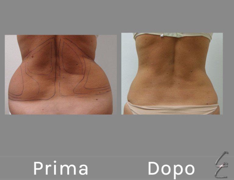 Liposcultura Laser Assistita Dott. Claudio Cordani